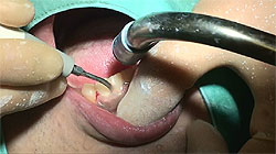 徹底的な歯石除去